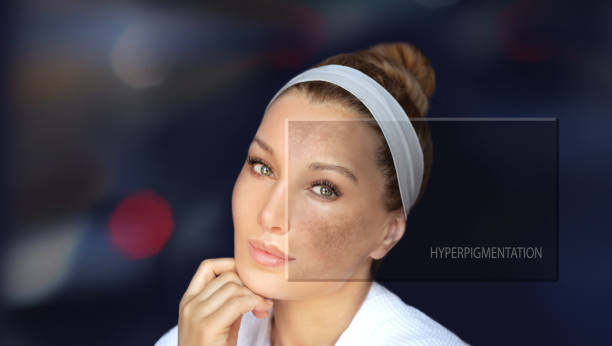 How to Treat Hyperpigmentation at Home